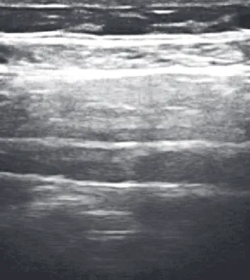 Fig. 1.  Transversus abdominis plane block.