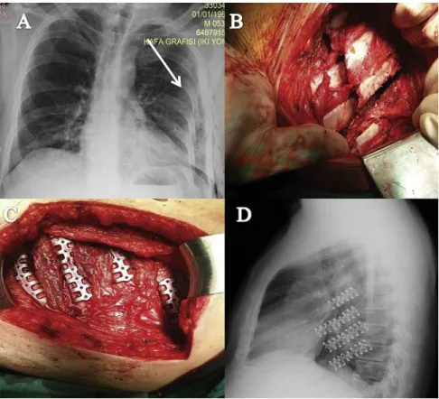 Fig 1. (A) Chest radiograph reveals obvious displaced fractures of left fourth to eighth ribs (arrow)