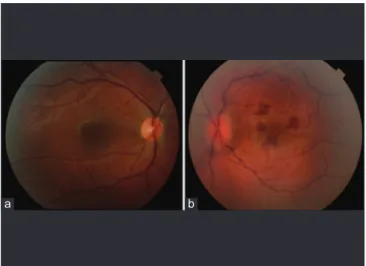 Figure 2: Fundus photography of the left eye on the 3 rd  day of the  presentation with central retinal artery occlusion