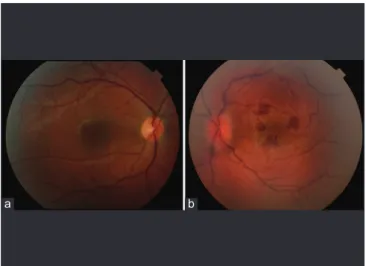Figure 2: Fundus photography of the left eye on the 3 rd  day of the  presentation with central retinal artery occlusion