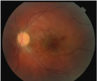 Figure 4: The left eye with the pale optic disc and attenuated arteries  on the 20 th  day of the presentation