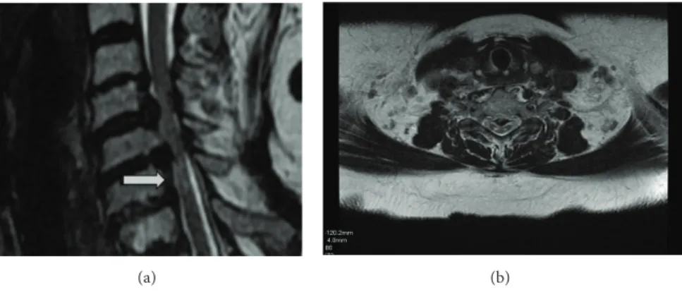 Figure 1: (a) and (b): T2-weighed MRI on sagittal and axial plans of spinal cord linear nonenhancing high signal intensity lesions.
