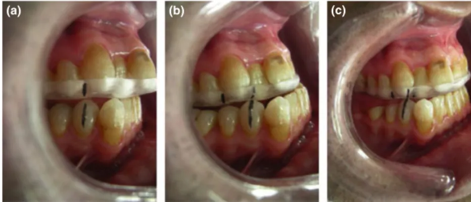 Fig. 2. (a) Vertical lines were marked on right lower pre-molar and upper occlusal splint at centic occlusion, (b) maximum protrusion, (c) approximately 75% of maximum protrusion.