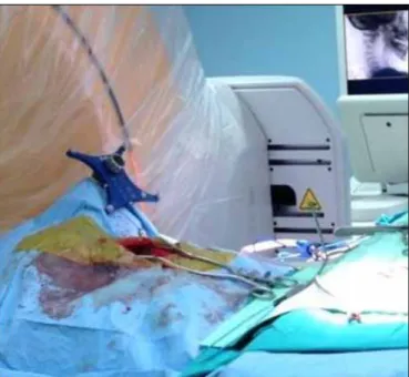 Table I: Summary of the Preoperative Demographics of Patients  Undergoing Pedicle Screw Placement with Intraoperative  Computed Tomography (iCT) Based Navigation