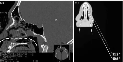 Fig. 2.  (a) Sagittal CT scan shows re-formation plane of perpendicular to estimated nasal airflow  axis