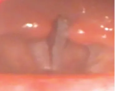 Fig. 1. Videolaryngoscopic image of the patient with paradoxical vocal cord motion at the time of attack