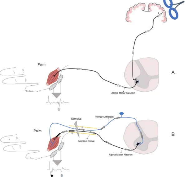 Fig. 1. The protocols used in the patient for electrophysiology. A) TMS application which was used to detect MEPs to assess corticospinal tract conduction and decussation.