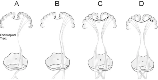 Fig. 6. Schematic illustration showing the proposed hypotheses of mirror movement arising from the ipsilateral motor cortex