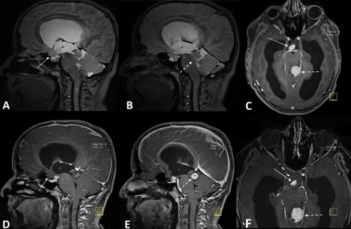 Figure 2. 3D-SPACE (T2W with variant FA mode) (A, B) and contrast-material enhanced MPRAGE (C–F) images of an NF-1  patient with optic pathway glioma (arrows) and aqueduct stenosis due to tectal glioma (dashed arrow).