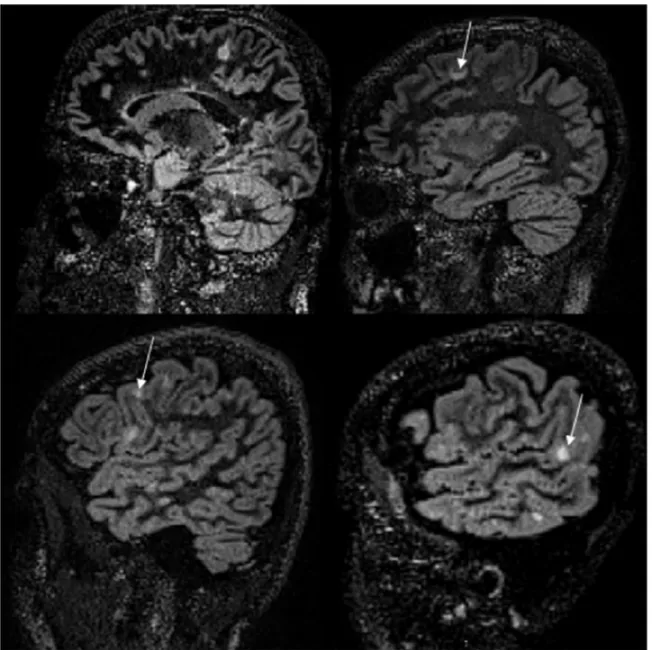 Fig. 1. Sagittal 3D DIR SPACE images obtained from four different patients show cortical/juxta-cortical hyperintense demyelinating lesions (arrows).