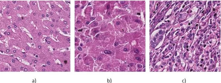 Figure 1: a) H&amp;E stained liver tissue of healthy patient, b) Grade 1 (well differentiated), c) Grade 2 (poorly differentiated) 