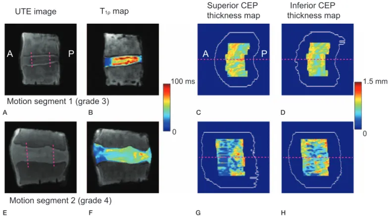Figure 6. (A–D) The mean and standard deviation of T 1r in the segmented disc and the mean and CV of CEP thickness averaged between the superior and inferior maps as a function of the Pfirrmann grade