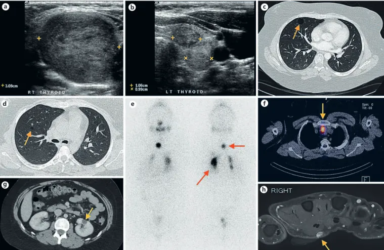 Fig. 1.  Diagnostic imaging.  a  Right thyroid ultrasound showing a  39 mm nodule.  b  Two nodules seen on left thyroid ultrasound,  measuring 1.06 and 0.99 cm, respectively