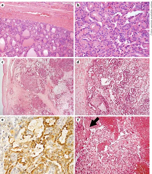 Fig. 2. a ,  b  Thyroid tumour.  a  Encapsulat- Encapsulat-ed follicular pattern neoplasm