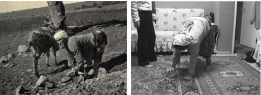 Figure 1. Quadrupedal gait in a male in 1914 (left) 16  (by courtesy of Prof. Dr. Üner  Tan)  and  in  a  female  patient  nowadays  (right) 18   (Reprinted  with  permission  from  Taylor and Francis Group, http://www.tandfonline.com)