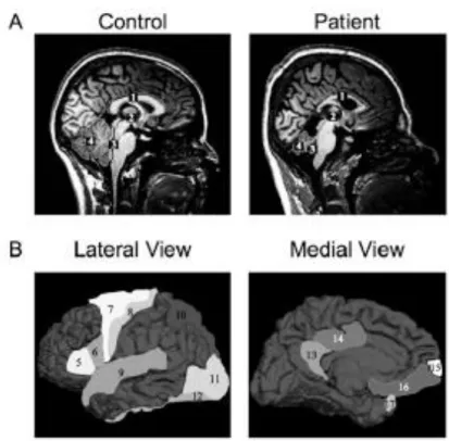 Figure 2. Brain morphology of a control individual and a patient were analyzed via  magnetic  resonance  imaging  (MRI)
