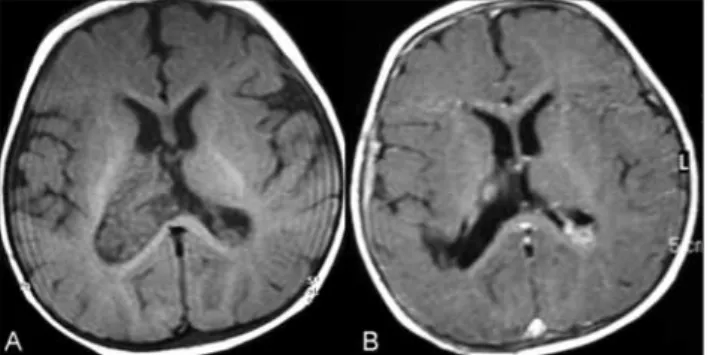 Figure 1: A. Axial T1-weighted precontrast image demonstrating right lateral ventricular mass and mildly dilated ventricles