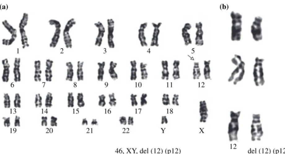 Figure 3. The karyotype (a) represents 46, XY, del (12) (p12), and partial karyotype (b) represents del (12) (p12).