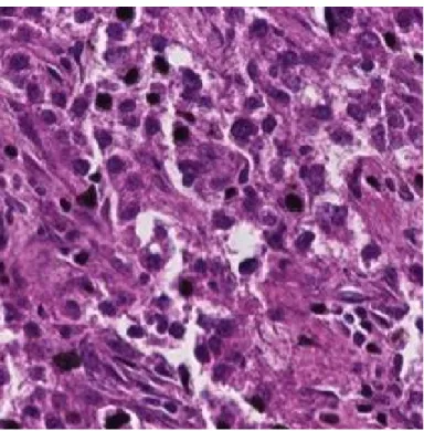 Figure 2.5: Microscopic Image of an H&amp;E Stained Grade II (CSC density&gt; 5%) Liver Tissue Image