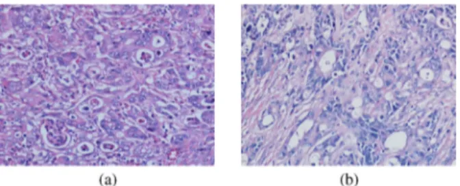 Fig. 5. Examples of the low-grade cancerous tissues that are incorrectly clas- clas-sified as high-grade cancerous by the color-graph approach