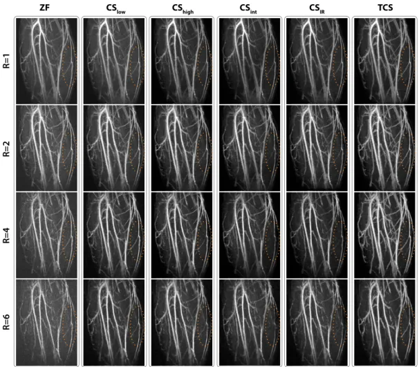 Figure 2.7: MIPs of lower leg angiograms reconstructed with ZF, CS IR and TCS, for R = 1-6