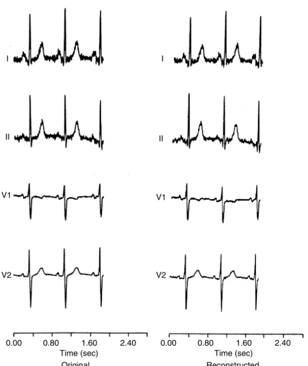 FIGURE 3.6 The original and reconstructed ECG lead signals I, II, V1, and V2 (CR = 6.17, APRD = 6).