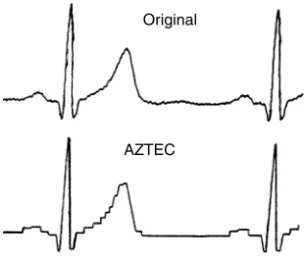 FIGURE 3.1 AZTEC representation of an ECG waveform.