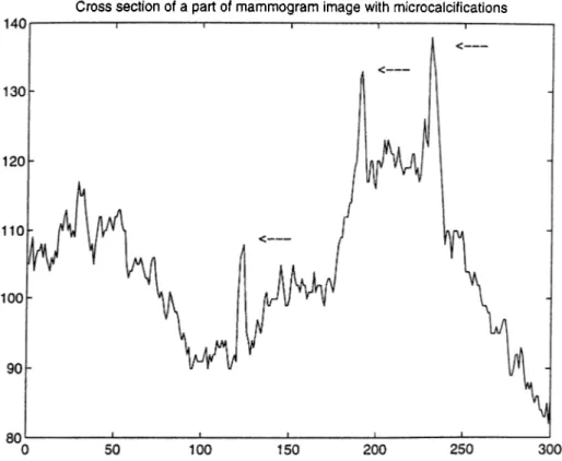 Figure 2.2:  Cross section of a part of a mammogram image with microcalcifications.  The  locations  of microcalcifications are  indicated  by  arrows.