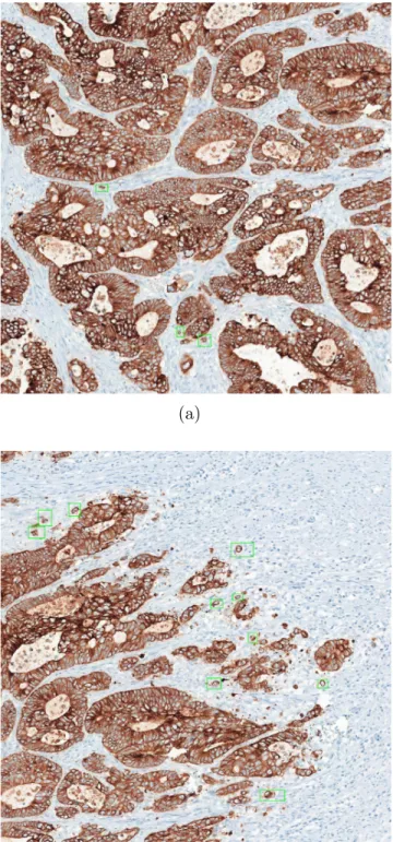 Figure 2.2: Examples of regions that have tumor buds. (a) Intratumoral budding region sample which is part of a big tumor mass
