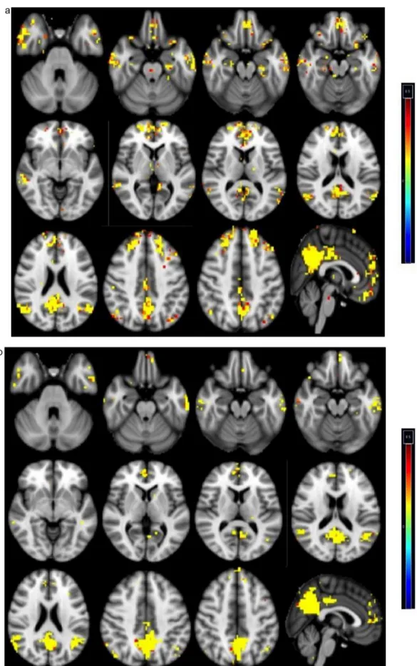 Fig. 2. Functional connectivity between the PCC and all other brain regions in the control group (A), in AD group (B)