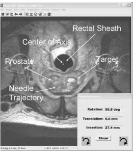 Fig. 7. Screen shot of the visualization and targeting program. An axial T2 weighted MR image containing prostate and rectal sheath is displayed.