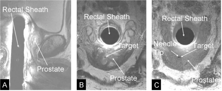 Fig. 10. MR images of the prostate. Panel A: Sagital T2 weighted MR image containing rectal sheath and prostate