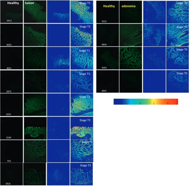 Fig. 5. FISH images of parafﬁn-embedded human colon tissues after incubation with 180-TO-PNA-MB.While the normal (‘‘healthy’’) tissues (left) show low (background) ﬂuorescence, the tumor and adenoma specimens (right) show profoundly high ﬂuorescence intens