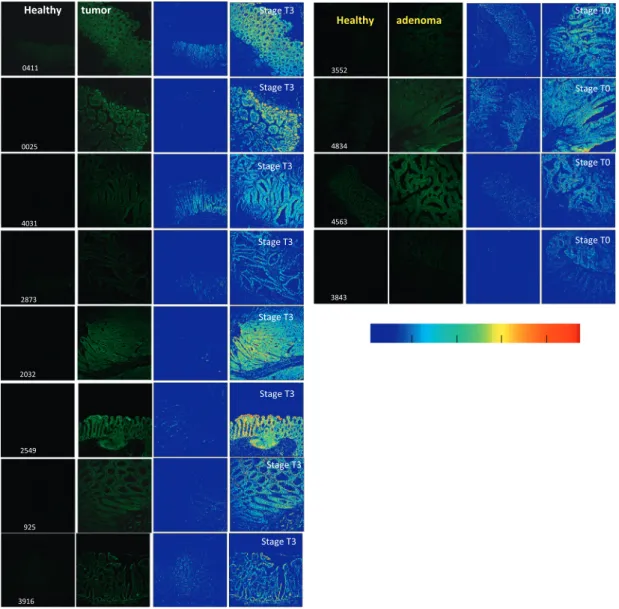 Fig. 5. FISH images of parafﬁn-embedded human colon tissues after incubation with 180-TO-PNA-MB.While the normal (‘‘healthy’’) tissues (left) show low (background) ﬂuorescence, the tumor and adenoma specimens (right) show profoundly high ﬂuorescence intens
