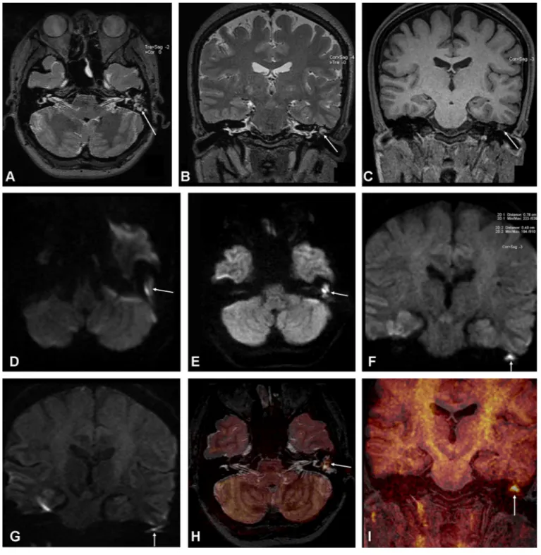 Fig. 2. Reformatted axial-coronal T2 W 3D-SPACE (A, B), and coronal MPRAGE (C) images of a 30-year-old female show soft-tissue that ﬁlled left middle ear (arrows)