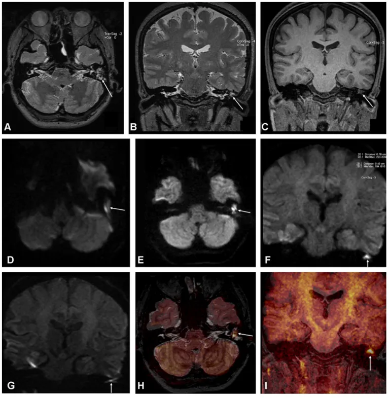 Fig. 2. Reformatted axial-coronal T2 W 3D-SPACE (A, B), and coronal MPRAGE (C) images of a 30-year-old female show soft-tissue that ﬁlled left middle ear (arrows)