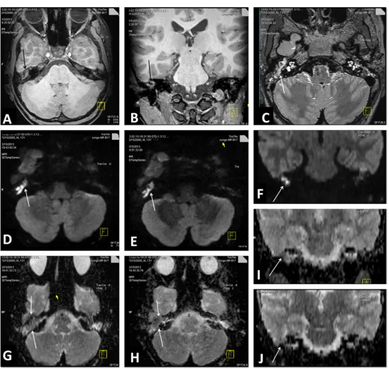 Fig. 3. MR images of cholesteatoma of the right middle ear in a 13-year old boy. Reformatted axial-coronal 3D-T1 W MPRAGE (A, B) and 3D-T2 W SPACE (C) images show soft-tissue in the right middle ear cavity (arrows)