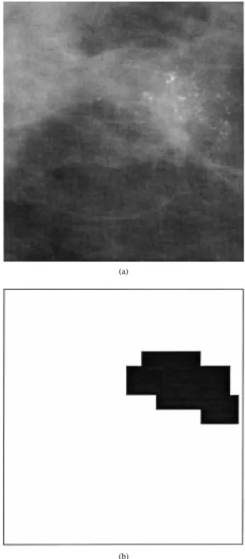 Fig. 1. Histogram of a region (a) with a microcalcification cluster and (b) without microcalcifications in the bandpass image.