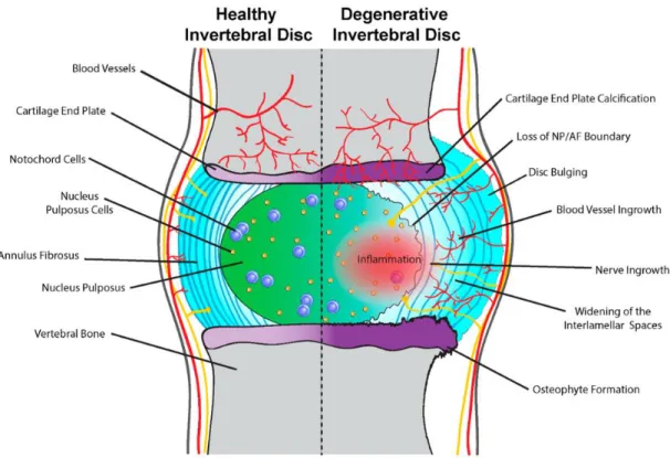 Figure  5  Schematic  representation  of  the  processes  observed  in  healthy  disc  vs