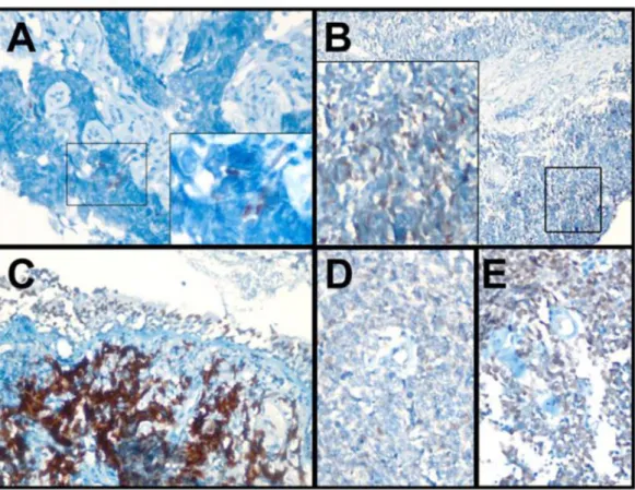 Figure 3.3: SOX2 Protein Staining by IHC. We used five tumor samples, three of them had  SOX2 antibodies against SOX2 antigen, and two patients were seronegative