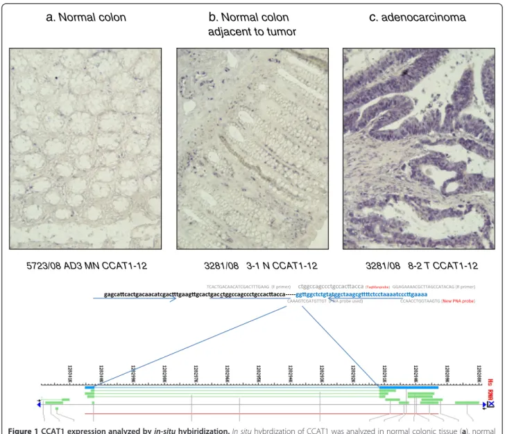 Figure 1 CCAT1 expression analyzed by in-situ hybiridization. In situ hybrdization of CCAT1 was analyzed in normal colonic tissue (a), normal mucosa adjacent to the primary tumor site (b) and in primary adenocarcinoma of the colon (c)