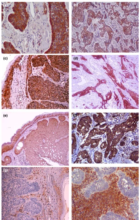 Figure 2 Significant NM23-H1 positivity is seen in both nodular (a) and infiltrative basal cell carcinomas (BCCs)