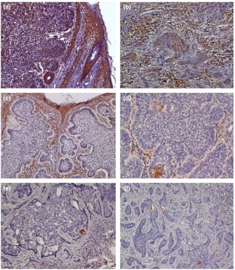 Figure 3 Normal skin adjacent to basal cell carcinoma (BCC) expresses medium strength nuclear and cytoplasmic MKK4 staining