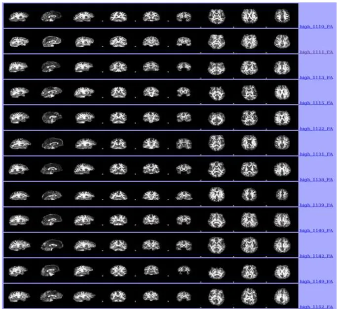 Figure 2.7.1.1. Automatically produced pre-processed brain images of first 12  participants in the high-level of ELS groups