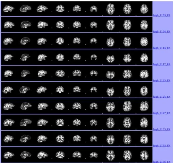 Figure 2.7.1.2. Automatically produced pre-processed brain images of last 10  participants in the high-level of ELS group 