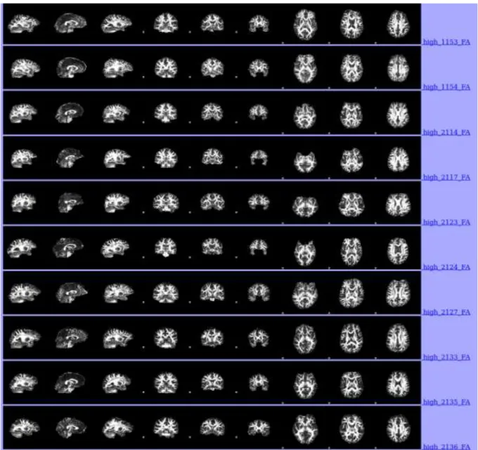 Figure 2.7.1.2. Automatically produced pre-processed brain images of last 10  participants in the high-level of ELS group 