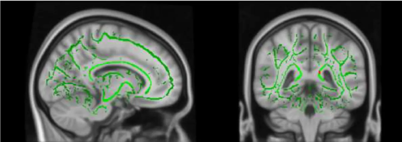 Figure 3.2.1. Insignificant FA value differences in the splenium of corpus callosum  between high-level of ELS and low-level of ELS groups 
