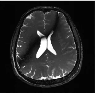 Figure 2.4: An example in vivo bSSFP image where banding artifact is observed as a dark band passing through the middle of the image.