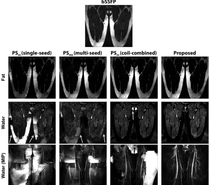 FIGURE 4: In vivo thigh images combined across 8 channels of a phased-array coil. First row: The unseparated bSSFP image shown as a reference