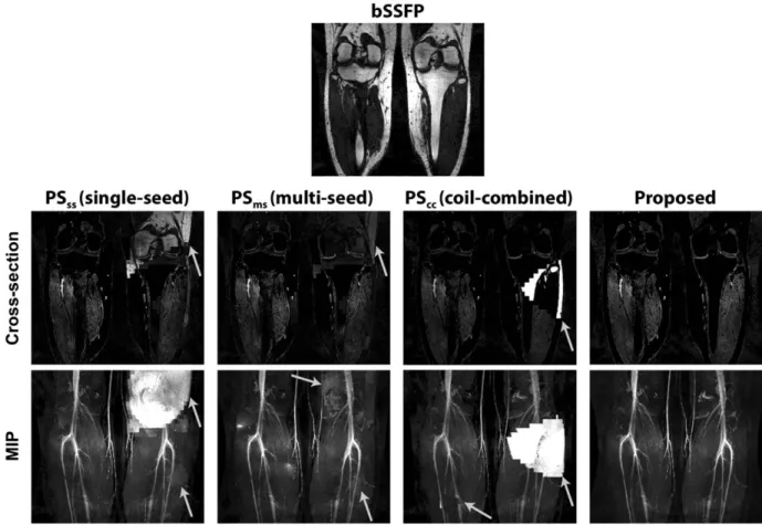 FIGURE 5: In vivo lower leg images combined across 8 channels of a phased-array coil. First row: The unseparated bSSFP image shown as a reference